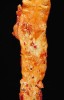 Podélně rozříznutá aorta postižená aterosklerózou – na vnitřním povrchu  se vytvořilo množství lézí. Převzato z Wikimedia Commons, v souladu  s podmínkami použití