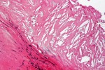 Histologický preparát ukazující  trhliny v cholesterolovém plátu. Převzato z Wikimedia Commons, v souladu  s podmínkami použití