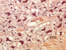 Cysty prvoků rodu Acanthamoeba na histologickém řezu kůží při nákaze pacienta s AIDS. Cysty v podobě nápadných nepravidelných útvarů jsou zde zachyceny v hojném počtu. Řez je obarven metodou hematoxylin a eozin. Foto E. Nohýnková
