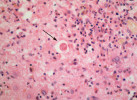 Histologické vyšetření centrálního nervového systému pacienta zemřelého na mozkovou toxoplazmózu. Na preparátu je patrná tkáňová cysta (zoitocysta obsahující bradyzoity, viz šipka), která je obklopená zánětlivě změněnou mozkovou tkání. Preparát byl zhotoven Patologickým oddělením Fakultní nemocnice Bulovka.