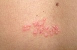 Pásový opar v oblasti mezižeberního nervu je způsoben reaktivací latentní infekce virem varicella-zoster. Tento virus po prodělání planých neštovic  setrvává v nervových gangliích a k jeho reaktivaci většinou dojde snížením  imunity. Výsev kožních projevů pásového oparu je provázen intenzivní bolestí. Včasné podání virostatika může přispět ke zmírnění příznaků a zkrátit dobu  trvání onemocnění. Foto z archivu Kliniky infekčních nemocí 3. LF UK v Praze a AIDS Centra Nemocnice Na Bulovce