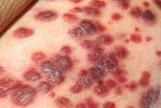 Kaposiho sarkom je nádorové onemocnění postihující zvláště často mužské pacienty s AIDS. Původcem je s největší pravděpodobností osmý lidský herpetický virus (HHV-8). Léčba je v současné době především cytostatická, ale pro úspěch terapie je stejně významné dosažení zlepšení imunity pomocí antiretrovirové terapie. Kdyby se podařilo vyvinout virostatikum dostatečně účinné proti HHV-8, znamenalo by to zřejmě další zlepšení prognózy nemocných. Foto z archivu autorů